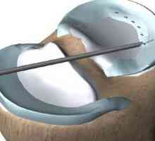 Operacija na koljenima, na meniskusu: recenzije. Rehabilitacija nakon operacije na meniskusu koljena