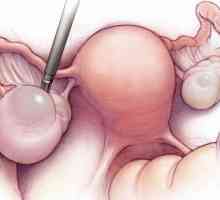 Operacija za uklanjanje cista jajnika