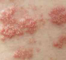 Herpes zoster: liječenje, simptomi i prevencija