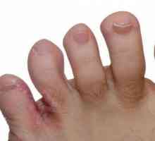Prijelom između prstiju: uzroci, simptomi i značajke liječenja