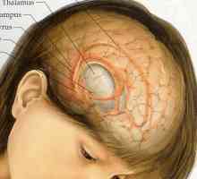 Tumor mozga: simptomi u ranoj fazi. Prvi znakovi tumora mozga