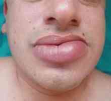 Puffy lip: četiri uzroka slabosti