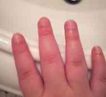 Puffy prsti na rukama: uzroci, dijagnoza, liječenje. Što učiniti ako su zglobovi na prstima natečeni