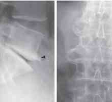 Osteofite - što je to? Osteofiti zgloba kuka i koljena, osteofiti kralježnice