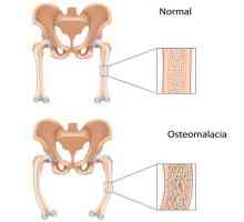 Osteomalazija: što je to, uzroci, simptomi, dijagnoza i značajke liječenja