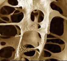 Osteopenija - što je to i koje su metode liječenja