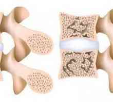 Osteoporoza kralježnice: simptomi i liječenje narodnim lijekovima