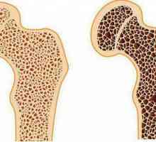 Osteoporoza zgloba kuka: simptomi i liječenje, dijagnoza