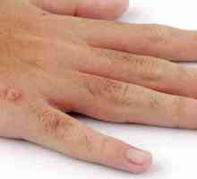 Što uzrokuje bradavice na rukama? Zašto se bradavice pojavljuju na prstima djece?
