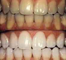 Izbjeljivanje zubi: vrste postupka i svojstva njegovog ponašanja