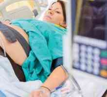 Odstupanja od norme "D-dimera" tijekom trudnoće