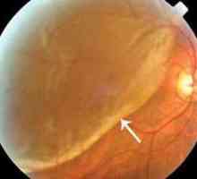 Dijeljenje retine, operacija: recenzije. Kako je operacija, oporavak