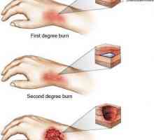 Opekline: područje opekline, određivanje po pravilu dlana. Razvrstavanje opeklina po površini i…