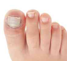 Prst na nozi narwhal: uzroci i liječenje