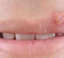 Papillomi u ustima: uzroci, liječenje, uklanjanje lasera