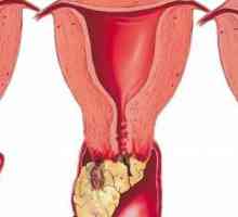 Papillomi u vagini: metode liječenja