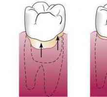 Parodontni džep: upala i liječenje