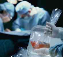 Transplantacija bubrega: operacija u kojoj se radi, život nakon intervencije, red