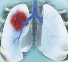 Periferni rak pluća: faze, liječenje, povijest bolesti. Karcinom perifernih režnja