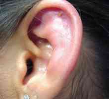 Perikondritis uha: simptomi, liječenje, fotografija