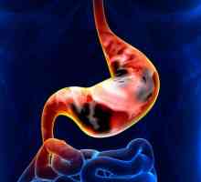 Karcinom prstenastog želuca: simptomi, prognoze i karakteristike liječenja