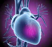 Prvi simptomi srčanog udara kod žena i muškaraca