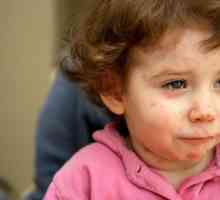 Alergija na hranu kod djece: simptomi, liječenje i posljedice