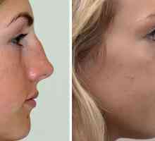 Plastična kirurgija na nosu: fotografije, recenzije