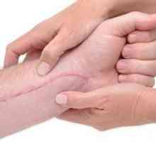 Silikonski žbuk, uklanjanje ožiljaka i ožiljaka: preporuke za upotrebu