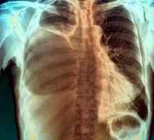 Pleurija s rakom pluća: opis, uzroci, simptomi i liječenje