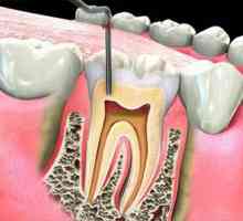 Ispunjavanje zubnih kanala: metode i materijali