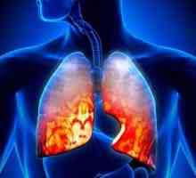 Pneumonija eozinofilna: opis, simptomi, uzroci i karakteristike liječenja