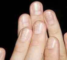Zašto nokti izgledaju kao bijele mrlje i što mogu reći?