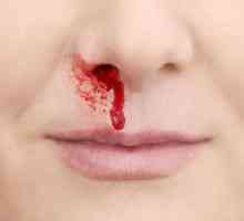 Zašto dijete ima krv iz nosa: uzroci i posljedice