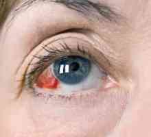 Zašto oči rastu krvne žile: uzroci i liječenje