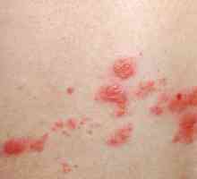 Na koži se pojavljuju crvene mrlje i svrbe: uzroci i liječenje
