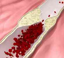 Indikacije za uporabu "Indapamid" - arterijska hipertenzija