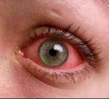 Crvenilo očiju kod djece: uzroci i načini liječenja