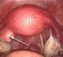 Polyp endometrija: liječenje bez operacije i pregleda