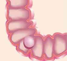 Polip u crijevima: simptomi i liječenje, operacija za uklanjanje
