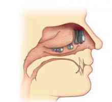 Polipi u nosu: liječenje bez operacije. Liječenje polipa u nosu s narodnim lijekovima