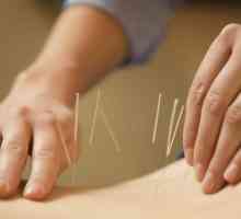 Prednosti akupunkture, indikacije i kontraindikacije, recenzije