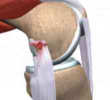 Nategnuti ligamenti na nozi: simptomi i liječenje