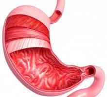 Površni gastritis: što je to? Uzroci, simptomi i metode liječenja