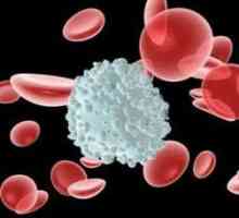 Povišeni limfociti u krvi: uzroci zahtijevaju pojašnjenje