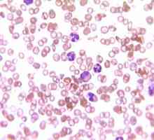 Povišene bijele krvne stanice u krvi: koji su uzroci i što je tretman?