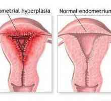 Lijek Norkolut: recenzije. S endometrijskom hiperplazijom, kako uzeti `Norkolut`? Što je bolje s…
