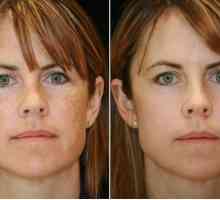 Uzroci i obrada pigmentacije lica