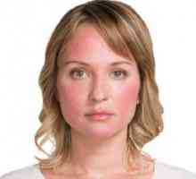 Uzroci couperose na licu i načine liječenja