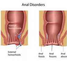 Uzroci i simptomi analnih pukotina. Analni pukotina: metode liječenja narodnim lijekovima